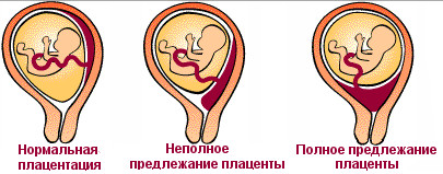 polojenie placenti u-children.ru